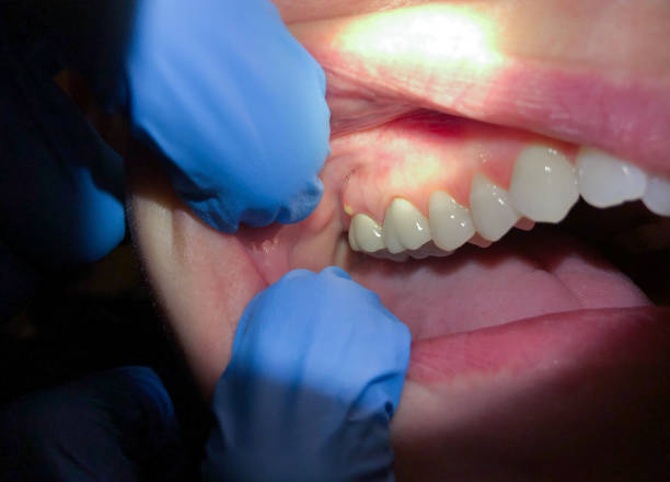 Best Broken or Cracked Tooth Emergency Dentist in North Pembroke, MA